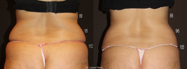 המסת שומן לפני ואחרי