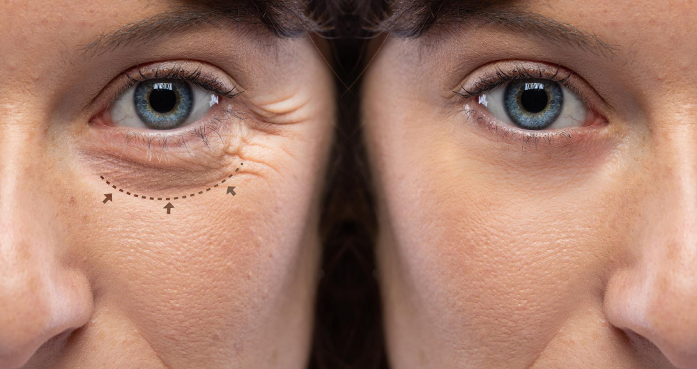 ניתוח עפעפיים